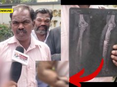 Man Alleges Medical Negligence At CBE Govt Hospital, Says Stapler Pin Left Inside Hand During Surgery Man Alleges Medical Negligence At CBE Govt Hospital, Claims Stapler Pin Left Inside Hand During Surgery
