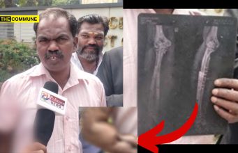 Man Alleges Medical Negligence At CBE Govt Hospital, Says Stapler Pin Left Inside Hand During Surgery Man Alleges Medical Negligence At CBE Govt Hospital, Claims Stapler Pin Left Inside Hand During Surgery